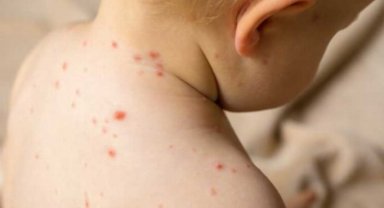 Risk grubundakiler için hayati tehlike olabiliyor