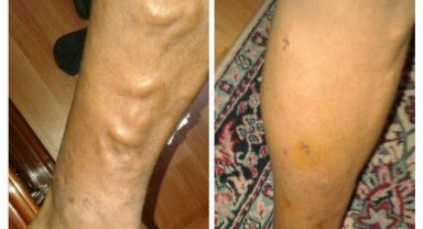 Sıcak havalarda varise dikkat!