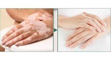 Dünyadaki birçok vitiligo hastası çareyi Bursa'da buluyor