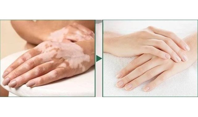 Dünyadaki birçok vitiligo hastası çareyi Bursa'da buluyor