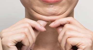 Gıdı Lazer Lipoliz (Lazer ile Gıdı Estetiği) nedir, nasıl yapılır?