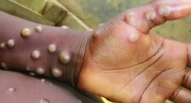 Maymun çiçeği virüsü nedir ve nasıl bulaşır?