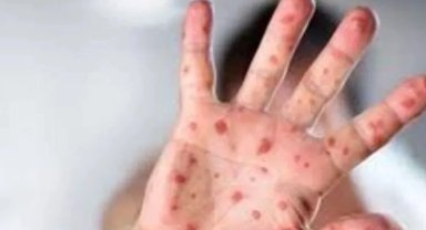 Maymun Çiçeği virüsüne karşı en dikkatli olması gereken sektör: Turizm