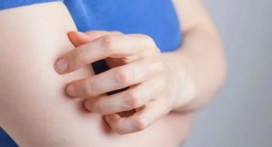 Uyuz vakaları artıyor