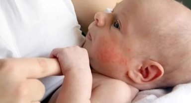 Alerjik bebeklerde emzirme düzeni nasıl olmalı?