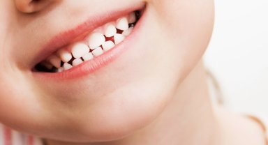 Dişler iyi temizlenmezse arayüz çürüğü oluşabiliyor