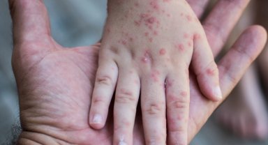 Küçük Ellerde Büyük Risk: El, Ayak, Ağız Hastalığına Dikkat!