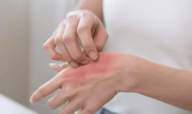 Kaşıntı yalnızca bir cilt sorunu olarak ele alınmamalı!