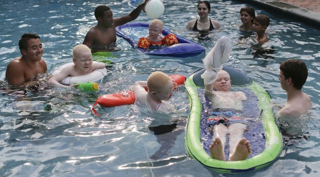 Albino Hastası Çocukların Mutlu Sonu