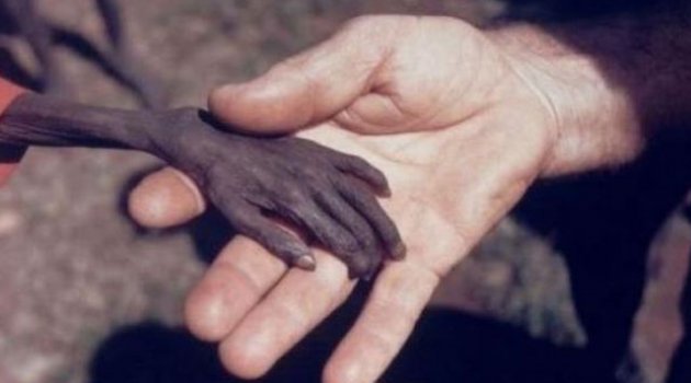 Çocuk ölümlerinin yüzde 40'ı yetersiz beslenmeden!