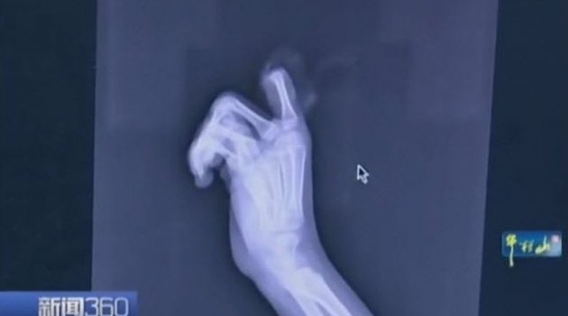 Küçük Çocuk Telefon Bağımlılığı Yüzünden Kendi Parmağını Kesti!