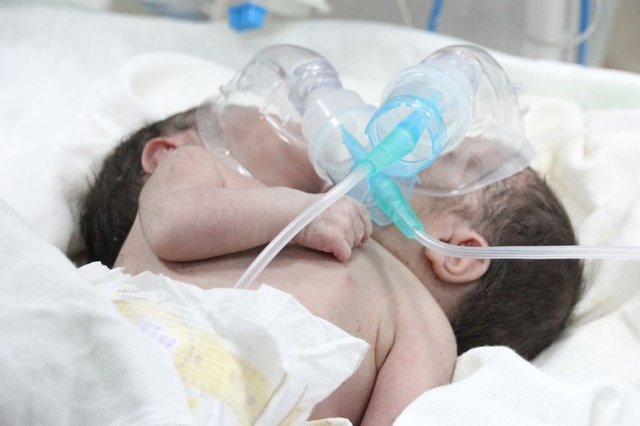 Suriye'de Çift Başlı Bebek Dünyaya Geldi