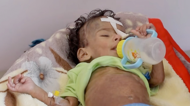 Yemenli çocuklar açlıktan ölüyor